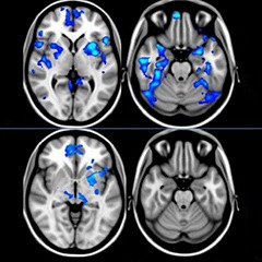 psilocybin brain